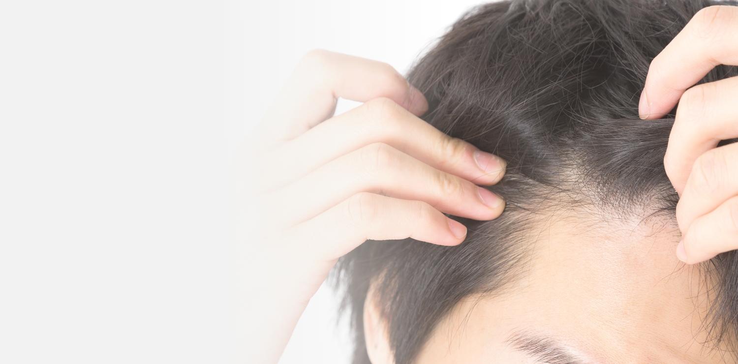 男性型脱毛症（AGA）の原因と治療方法