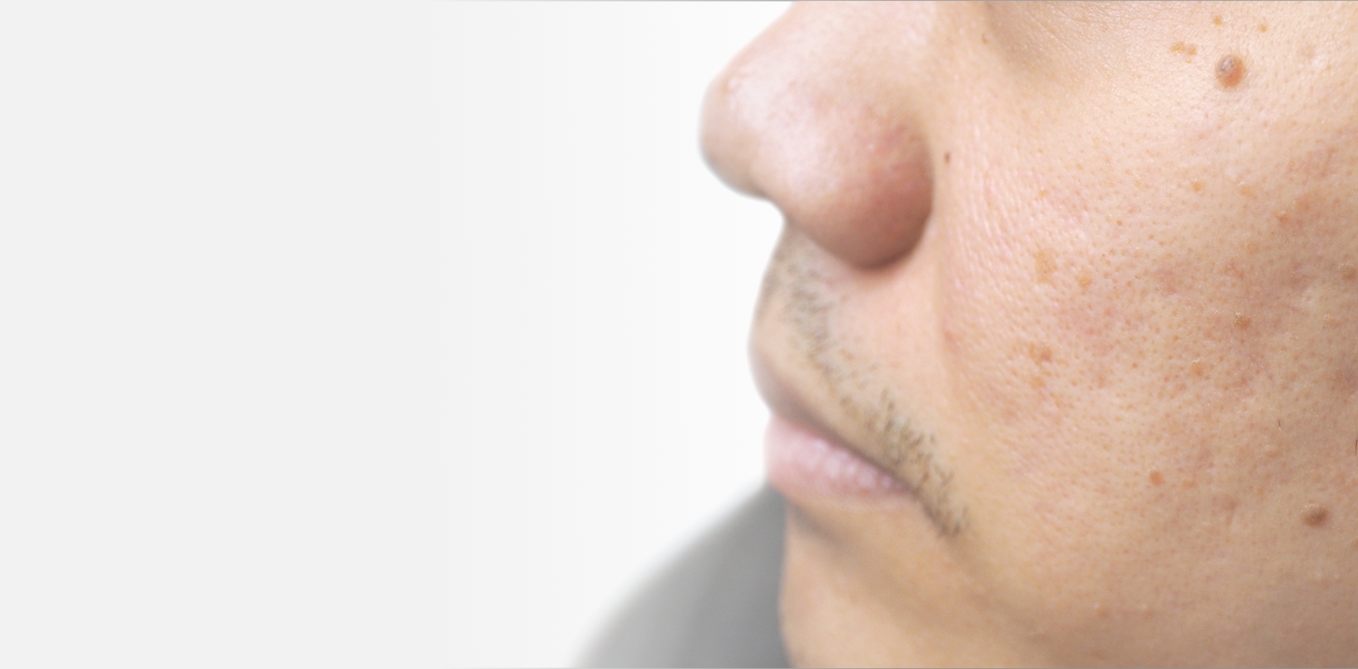 ほくろ ほくろができる原因と治療方法について Dクリニック東京plus